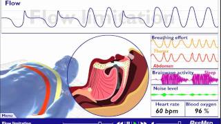 Understanding Sleep Disordered Breathing [upl. by Rosamond]