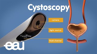 Cystoscopy overactive bladder [upl. by Ydner]