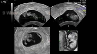 Baby Ultrasound early pregnancy 56789 weeks 3D [upl. by Assyram]