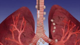 EBUS Procedure OverviewOlympus Bronchoscopy [upl. by Encratia]