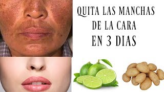 ELIMINA las MANCHAS de la CARA en SOLO 3 NOCHES  REMEDIO CASERO [upl. by Ettinger]