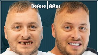 Simon from UK did dental implants in Turkey and got an AMAZING RESULT [upl. by Enibas]