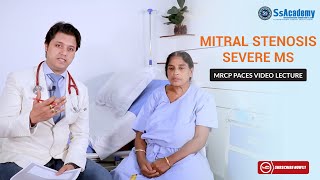 MRCP PACES Clinical Case  Cardiology  Severe Mitral Stenosis MS [upl. by Vannie]