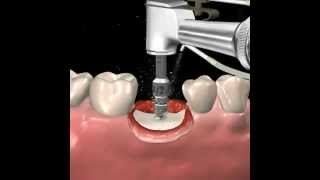 Step by step dental implant surgery Gary R OBrien DDS [upl. by Enajiram]