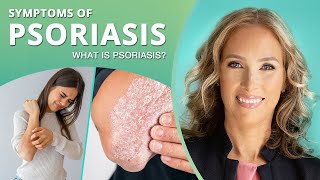 Symptoms of Psoriasis  Dr J9 Live [upl. by Rani285]