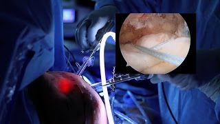 Rotator Cuff Repair Surgery  Vail CO [upl. by Festus]