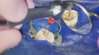 Endodontiste Hugo Setbon  Le retraitement endodontique [upl. by Nyvek]