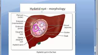 Pathology 617 a hydatid cyst morphology pericyst liver capsule sand fluid echinococcus [upl. by Gusta]