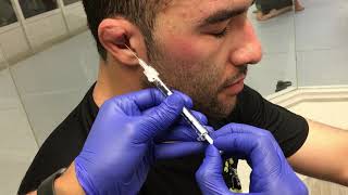 Treating Cauliflower Ear J2LATOS Long Beach [upl. by Hamimej981]