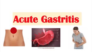 Acute Gastritis Stomach Inflammation  Causes Signs amp Symptoms Diagnosis Treatment [upl. by Rehtaeh]