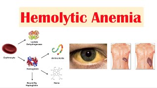 Hemolytic Anemia [upl. by Mapel]