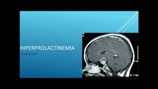 Hiperprolactinemia Tumor hipofisario [upl. by Itteb]