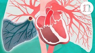 Pulmonary embolism The route to recovery [upl. by Weiler]