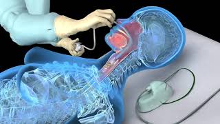 Nasotracheal suctioning NTS  3D animation [upl. by Nemlaz]