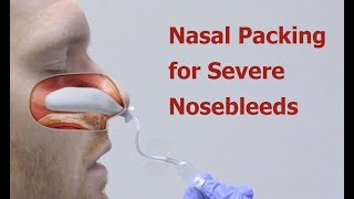 Nasal Packing for Severe Nosebleeds [upl. by Terhune760]