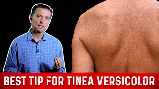 How I Remove Skin Tags At Home Fast amp Easy [upl. by Trixie]