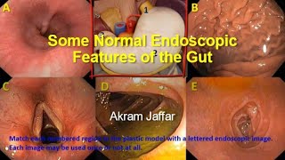 Some normal endoscopic features of the gut [upl. by Ade617]