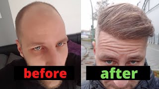 From Day 0 to Month 12  Hair Transplant Turkey Comparison [upl. by Ellebanna]