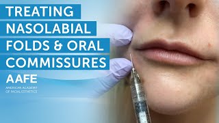 Using Dermal Fillers to Fill and Smooth Smile Lines  AAFE [upl. by Aylward]