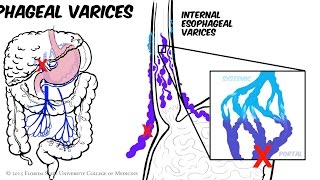 Portal Hypertension Animated Review [upl. by Judie]