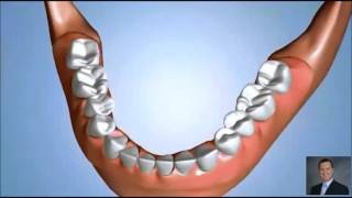 Jaw Atrophy and Denture Relines  Pasadena TX Dentist [upl. by Pirzada]