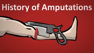 The History of Amputation Explained [upl. by Llerrot]