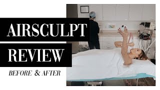 5Month Airsculpt Review  Before amp After [upl. by Cryan]