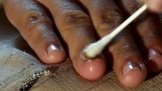 How to Cure Nail Fungus [upl. by Aillil]