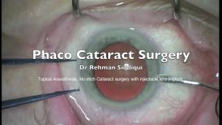 Phaco Cataract Surgery High Definition HD [upl. by Notrem]