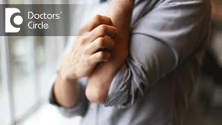 How to manage rashes with severe itching all over the body  Dr Sachith Abraham [upl. by Ynatil]