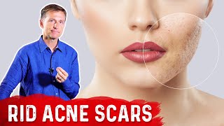 Best Way to Rid Acne Scars [upl. by Secunda]