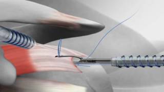 Rotator Cuff Repair with Arthrex® SutureBridge™ [upl. by Uriisa]