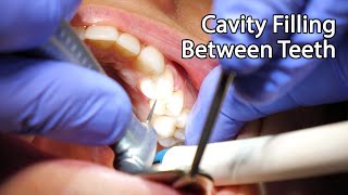 Dentist Filling A Cavity Between Teeth [upl. by Aiyotal]