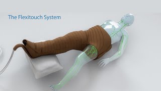 Treating Lymphedema  The Flexitouch System Lymphedema Pump [upl. by Colburn171]