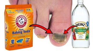 How To Get Rid of TOENAIL FUNGUS With Baking Soda amp Vinegar [upl. by Adnohsek731]