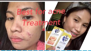 THE BEST FOR ACNE TREATMENT THE T3 MYCIN CLINDAMYCIN LOTION [upl. by Morey]