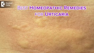 Detailed causes of URTICARIA or HIVES  Homeopathic Remedies DrVBhagyalakshmi  Doctors Circle [upl. by Myriam12]