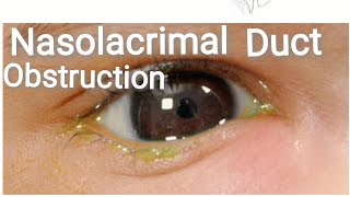 Lacrimal System  Anatomy  Congenital nasolacrimal duct obstruction Part 1 [upl. by Cristy]