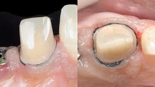 Dental basics Gingival Retraction  The two cord technique [upl. by Horlacher]