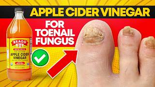 What Ive Learned from Using Apple Cider Vinegar for Toenails Fungus [upl. by Arait]