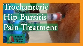 Trochanteric Hip Bursitis Pain Treatment  Auburn Medical Group [upl. by Lyndell383]