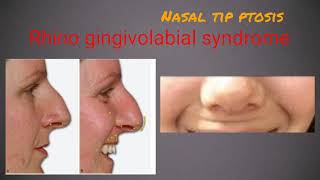 Nasal tip lift and nasal flare correction by botox [upl. by Petie962]