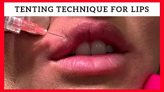 Tenting Technique for Lip Enhancement by Dr Steven F Weiner [upl. by Cindra]