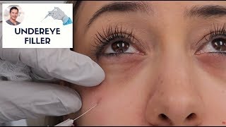 Undereye Filler By Leif Rogers MD FACS  Fanning Technique  Beverly Hills [upl. by Eric9]