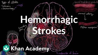 Hemorrhagic strokes  Circulatory System and Disease  NCLEXRN  Khan Academy [upl. by Trotter]