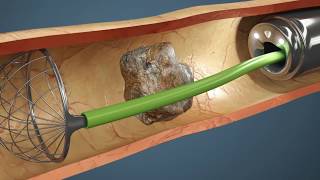 Como é feita a Cirurgia de Pedra nos Rins Vídeo da cirurgia em 3D [upl. by Laurentia]