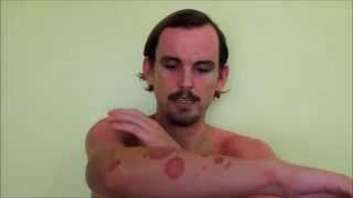 Cure Guttate Psoriasis Naturally  Heal Psoriasis [upl. by Tijnar347]