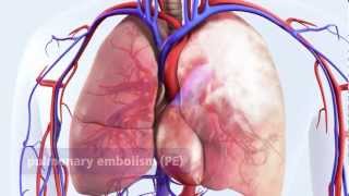 DVT can lead to pulmonary embolism PE [upl. by Anyotal]