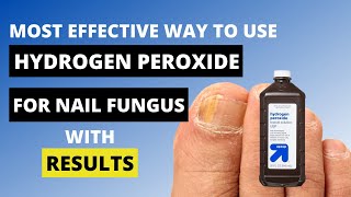 3 Ways to Use Hydrogen Peroxide for Nail Fungus  Toe Fungus Journey [upl. by Idroj855]