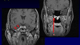 Imaging of the Nasopharynx [upl. by Aer436]